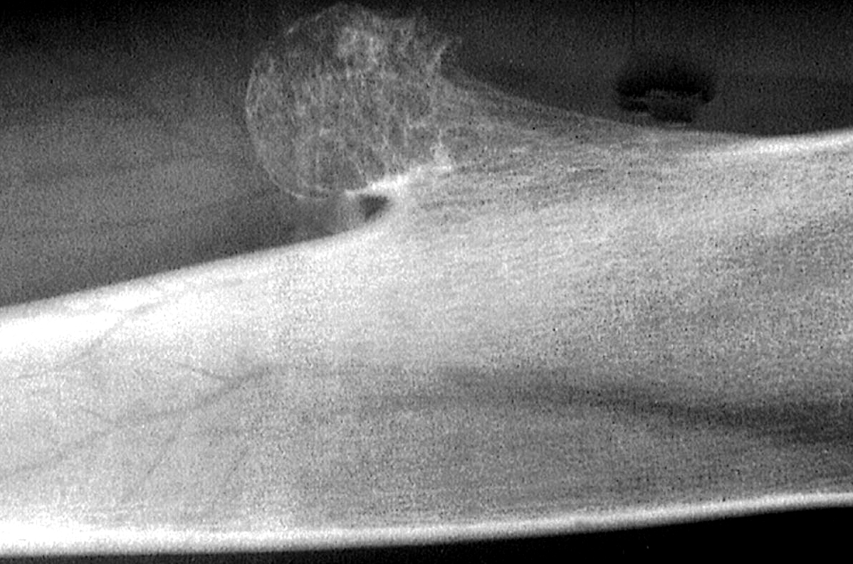 Pathology Outlines Osteochondroma